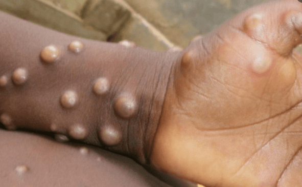 英国：猴痘患者痊愈前避免性行为